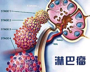 淋巴癌1.jpg