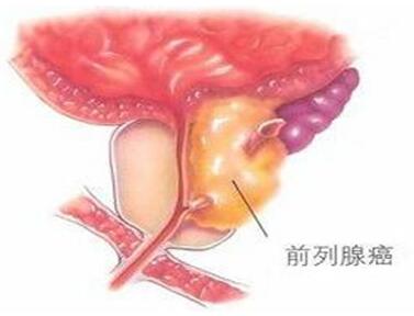 前列腺癌晚期怎么治疗好