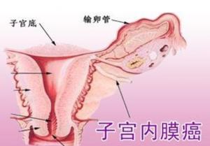 子宫内膜癌晚期症状