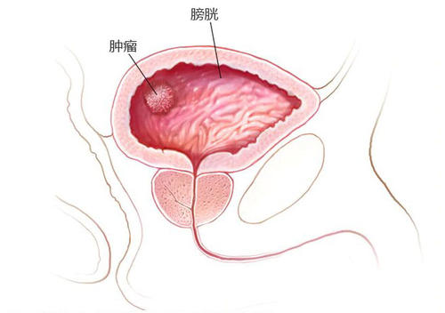 郑州中医肿瘤门诊：引起膀胱癌的病因